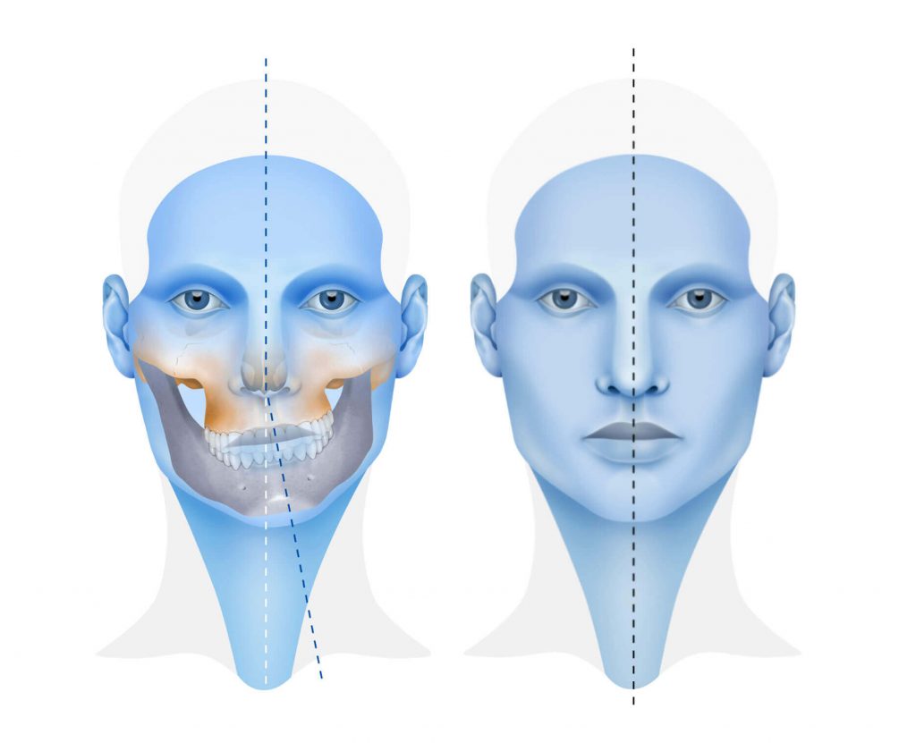 Gráfica sobre la asimetría mandibular uno de los tipos de cirugía maxilar