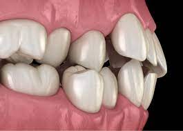 Imagen que muestra una dentadura con apiñamiento los dientes están muy juntos y no crecen alineados uno junto al otro