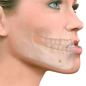 Imagen que muestra cómo en el prognatismo la mandíbula inferior es bastante prominente en relación a la mandíbula superior