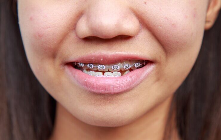 Sonrisa de joven que sufre de prognatismo, su mandíbula inferior es más prominente que la superior.