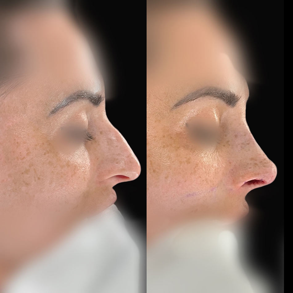precio rinoplastia malaga