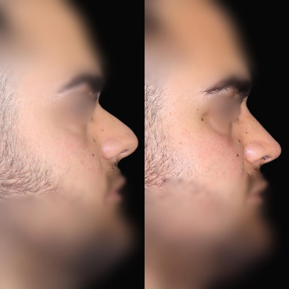 rinoplastia funcional malaga
