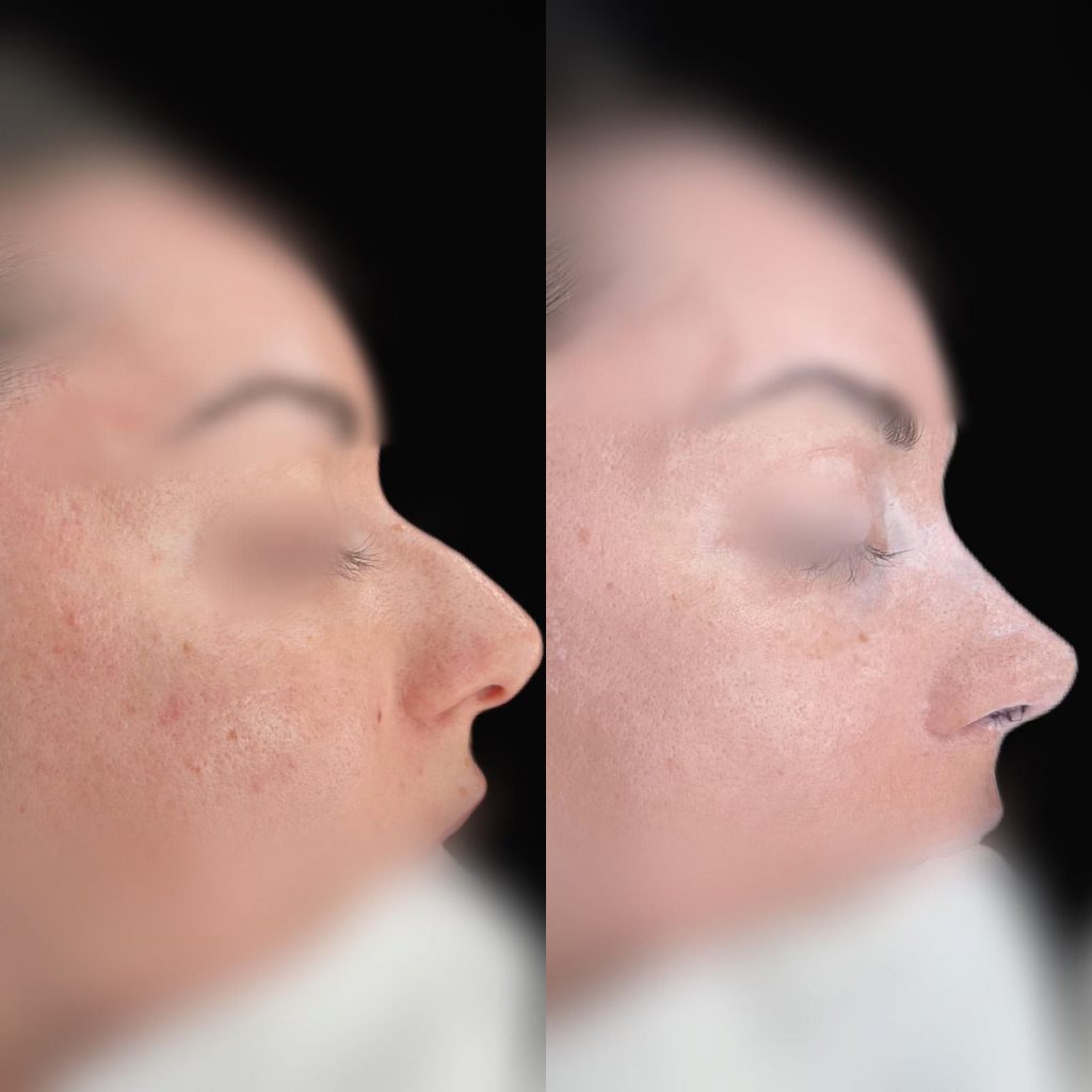 rinoplastia malaga precio