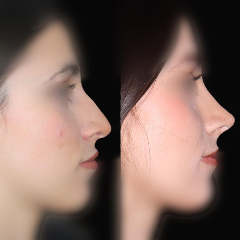 rinoplastia malaga opiniones