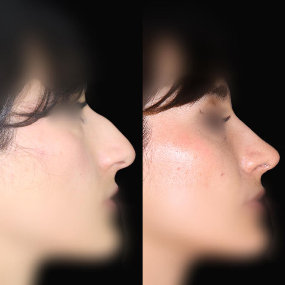 clinicas rinoplastia malaga