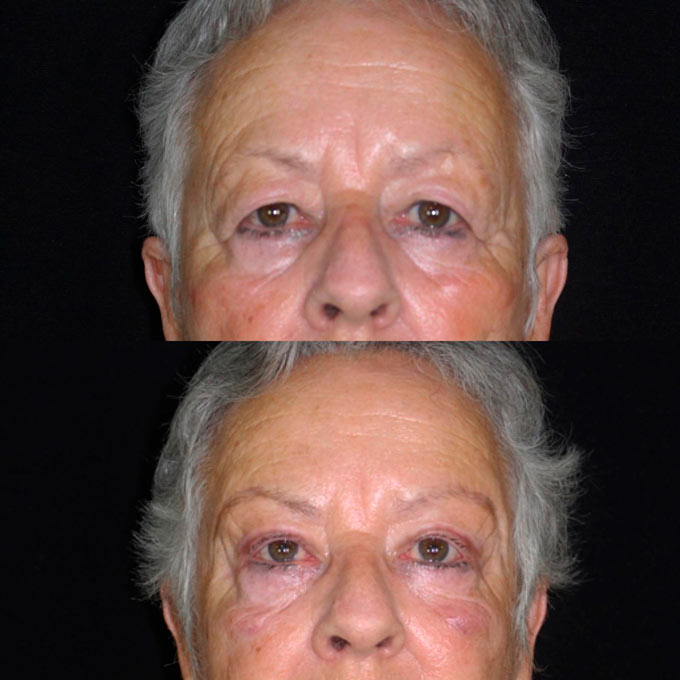 cirugía estética de ojos Málaga