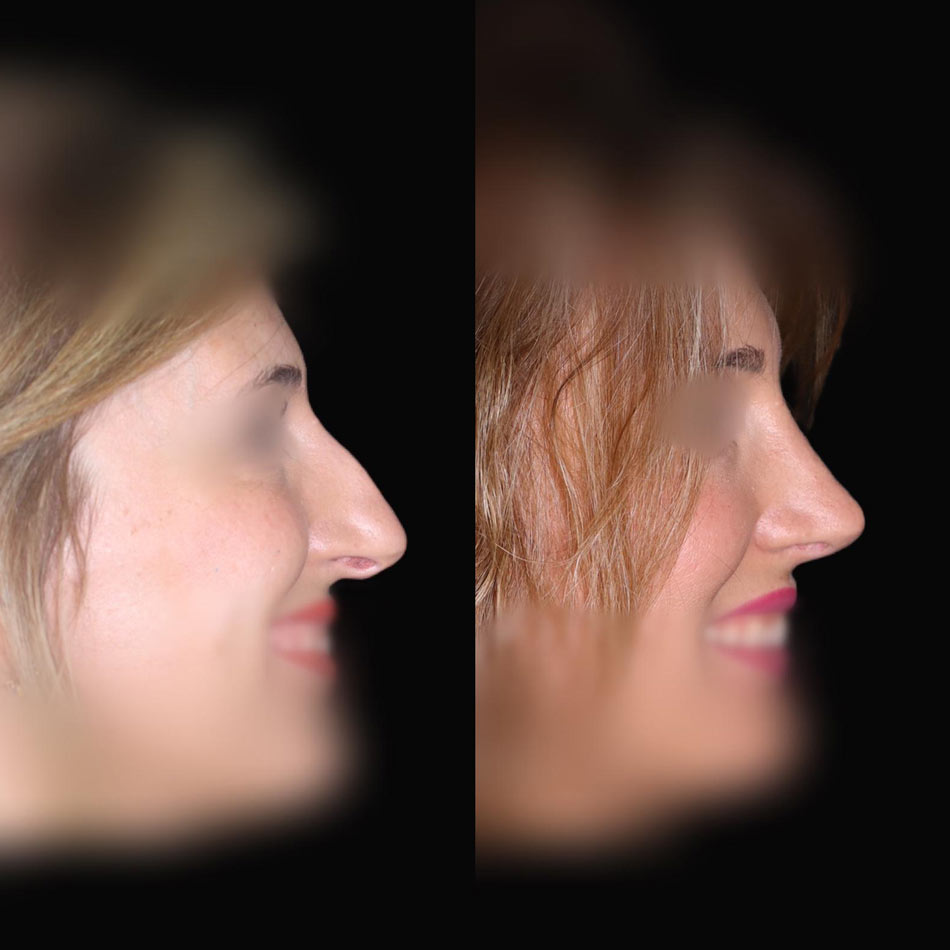 cirugia nariz malaga