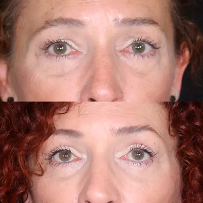 precio blefaroplastia malaga