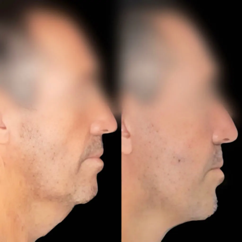 lifting facial fuengirola ejemplo