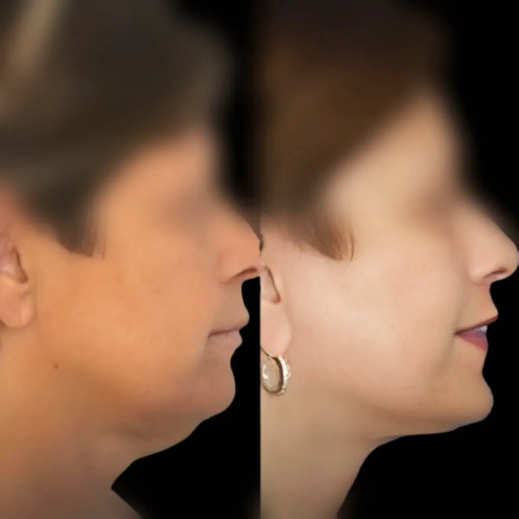 antes despues lifting facial fuengirola