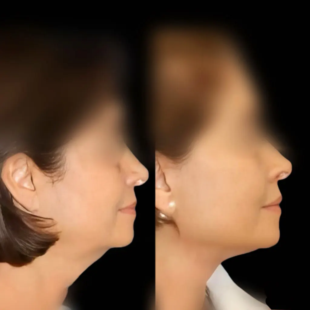 resultados lifting facial marbella