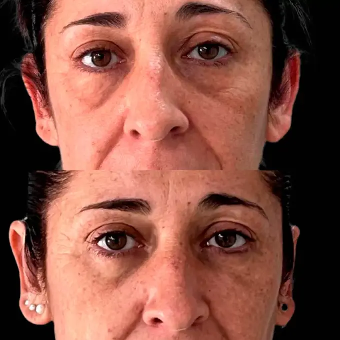 mejor cirujano blefaroplastia fuengirola