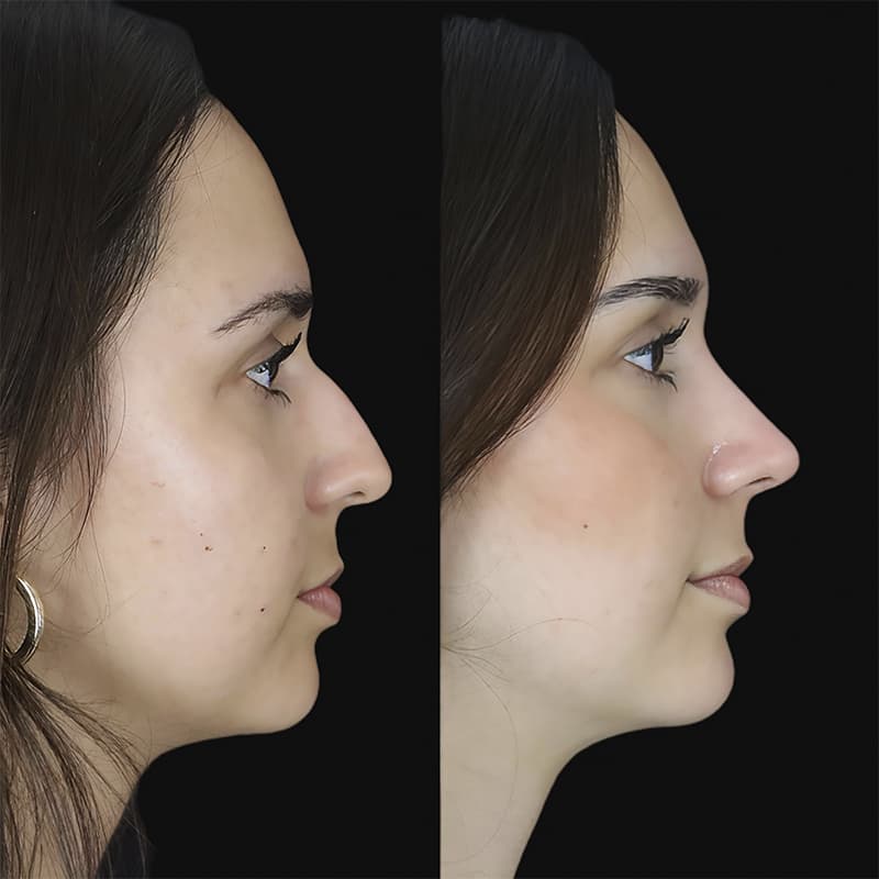 rinoplastia malaga antes y despues caso1 plano1 1