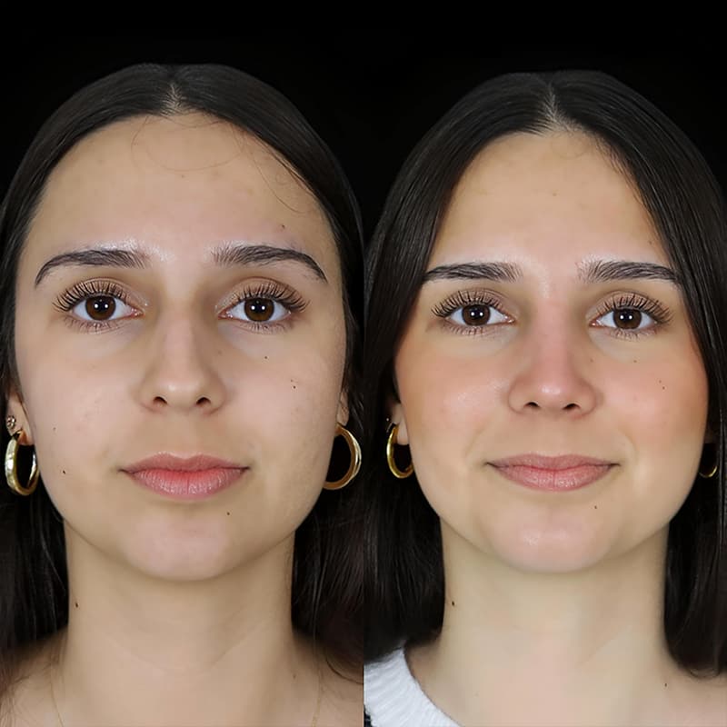 rinoplastia malaga antes y despues caso1 plano2 1