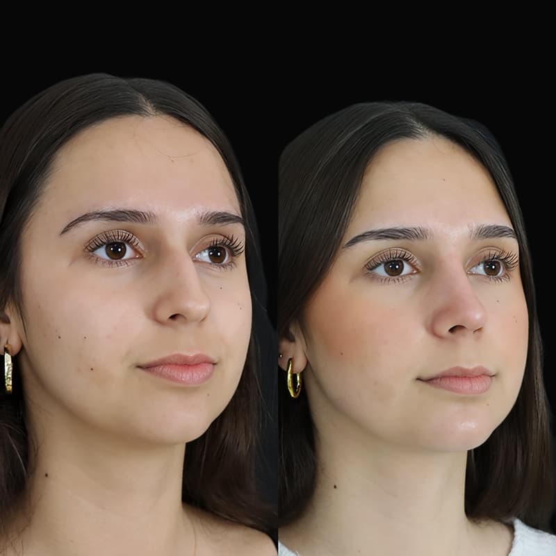 rinoplastia malaga antes y despues caso1 plano3 1