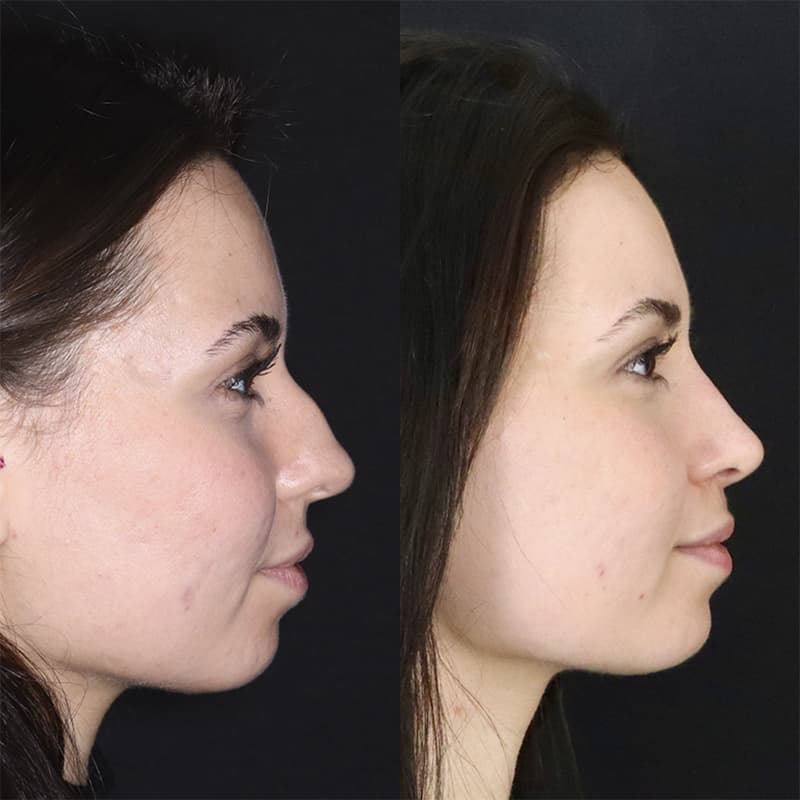 rinoplastia malaga antes y despues caso2 plano1 1