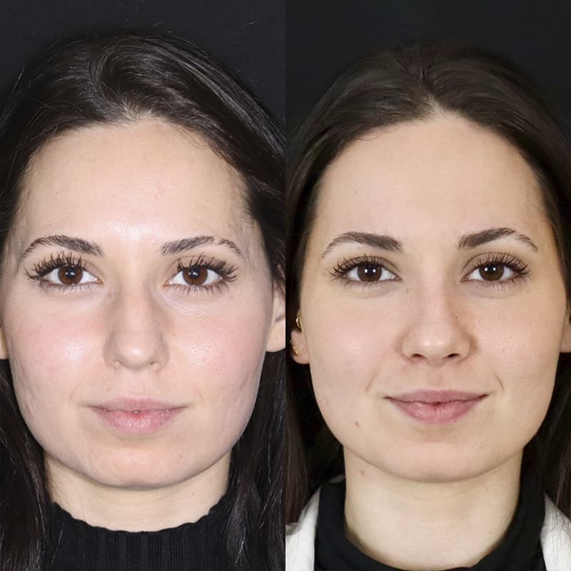 rinoplastia malaga antes y despues caso2 plano2 1