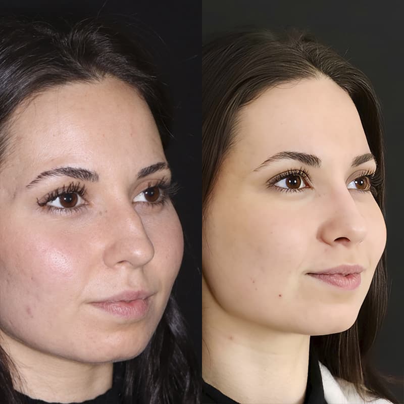 rinoplastia malaga antes y despues caso2 plano3 1
