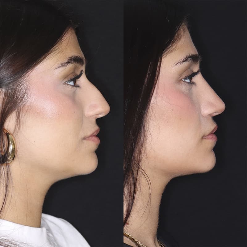 rinoplastia malaga antes y despues caso3 plano1 1