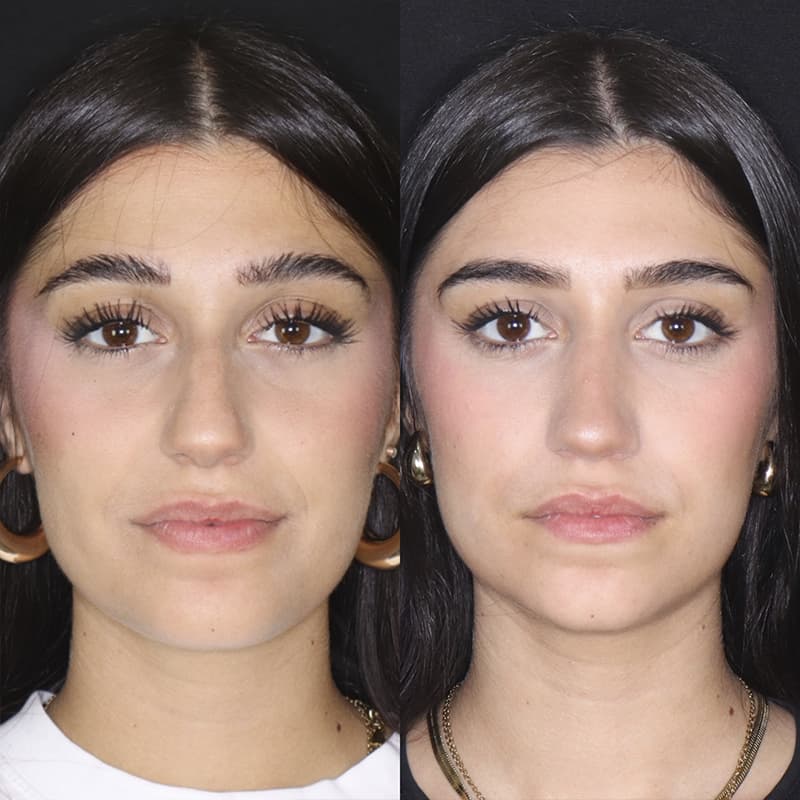 rinoplastia malaga antes y despues caso3 plano2 1