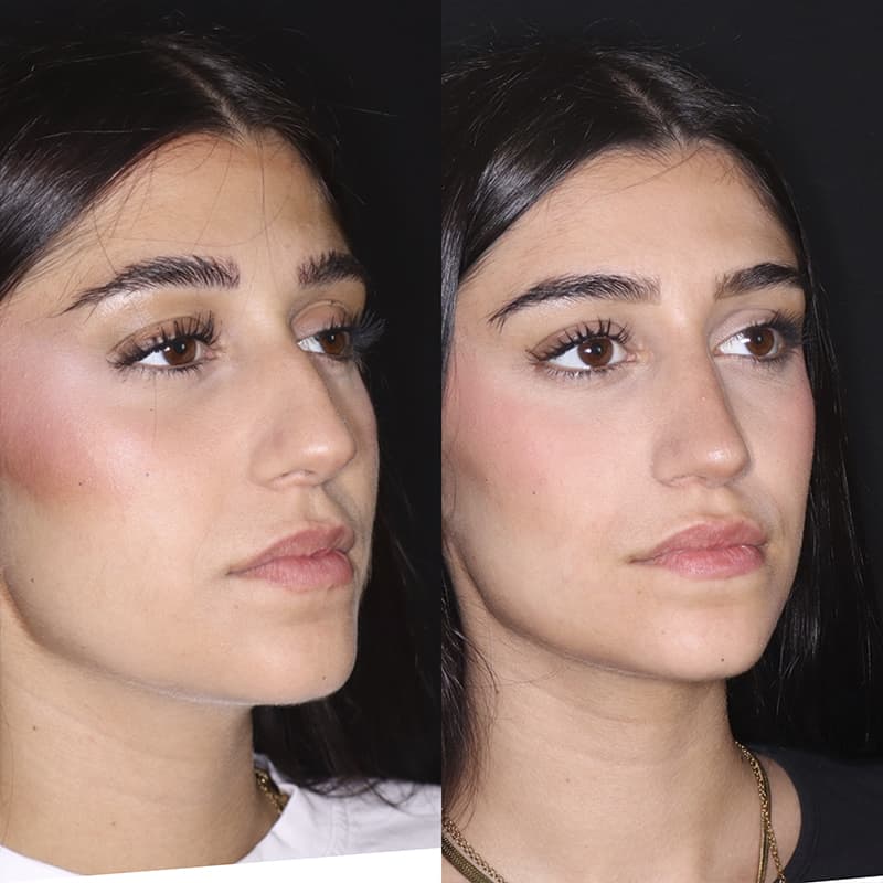 rinoplastia malaga antes y despues caso3 plano3 1