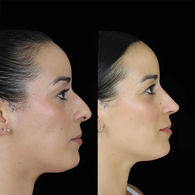 rinoplastia malaga antes y despues caso4 plano1 1