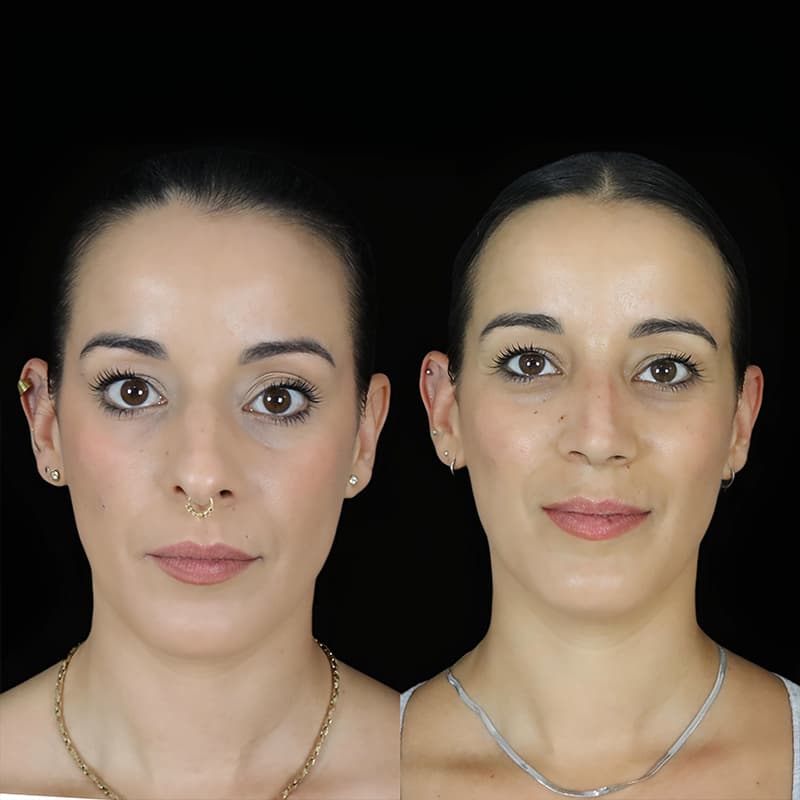 rinoplastia malaga antes y despues caso4 plano2 1