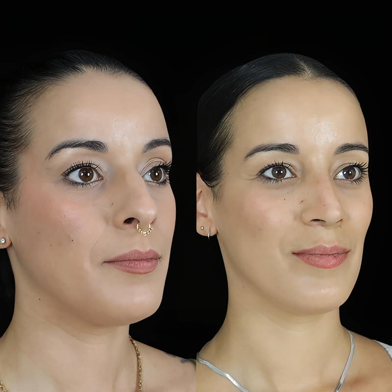 rinoplastia malaga antes y despues caso4 plano3 1