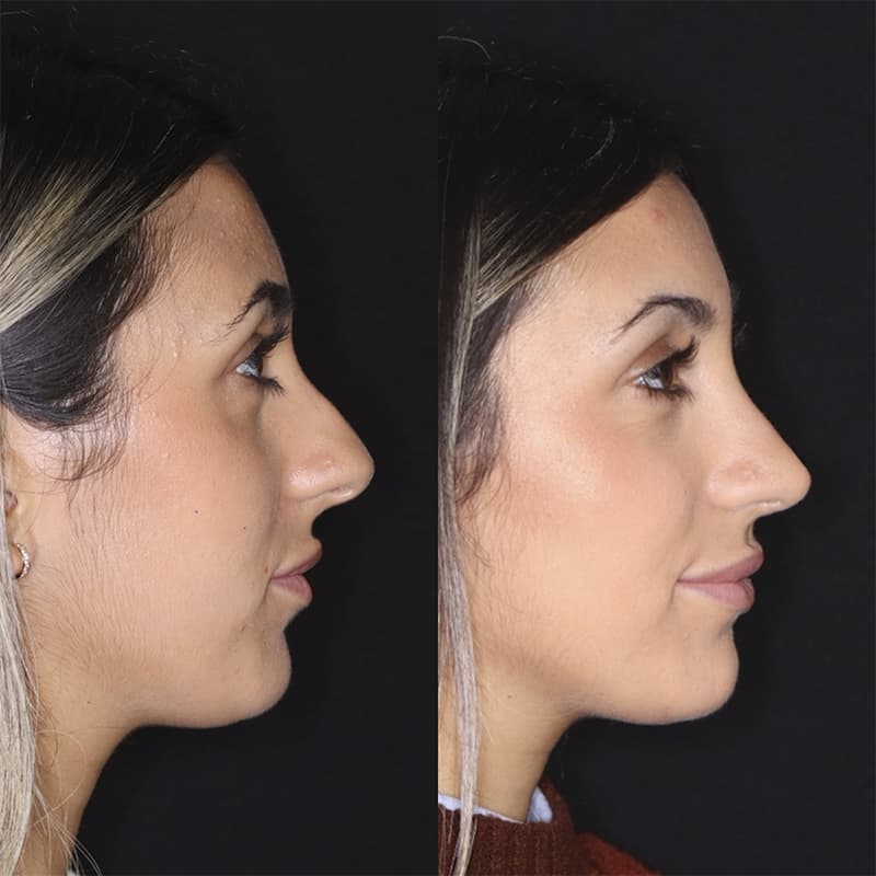rinoplastia malaga antes y despues caso5 plano1 1