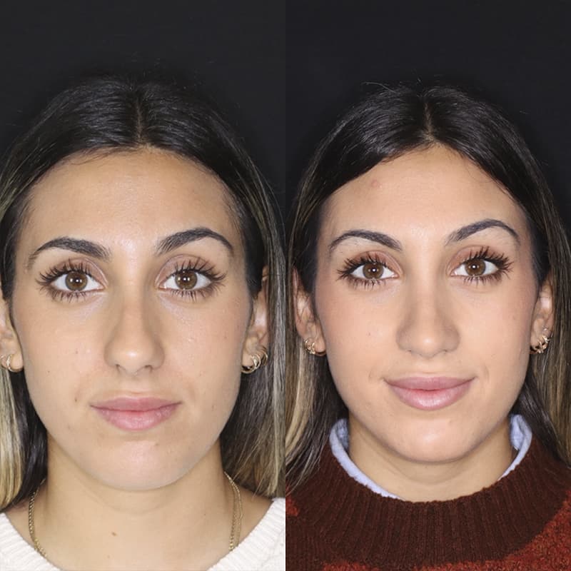 rinoplastia malaga antes y despues caso5 plano2 1