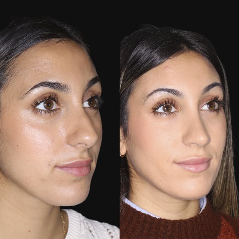 rinoplastia malaga antes y despues caso5 plano3 1