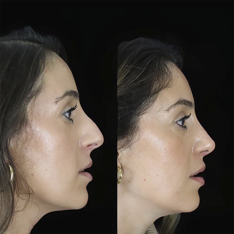rinoplastia malaga antes y despues caso6 plano1 1