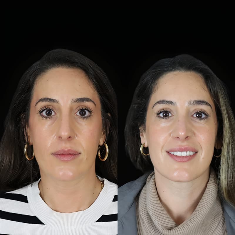 rinoplastia malaga antes y despues caso6 plano2 1