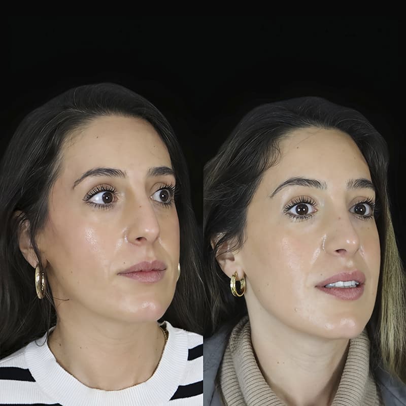 rinoplastia malaga antes y despues caso6 plano3 1